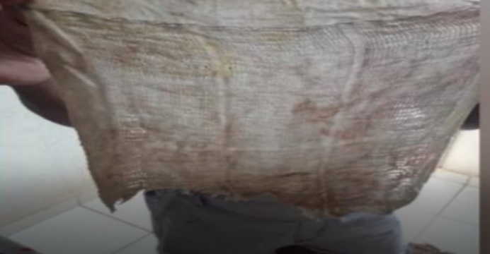 MULHER PASSA 6 MESES COM PEDAÇO DE PANO DENTRO DO ÂNUS APÓS CESÁREA