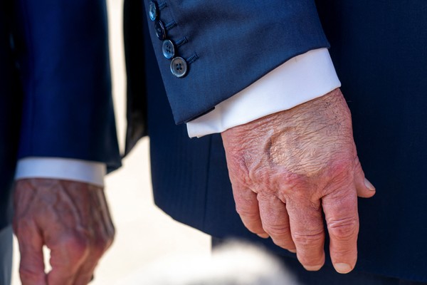 Trump foi flagrado com mão maquiada e pés inchados antes de diagnóstico de insuficiência venosa crônica; VEJA FOTOS