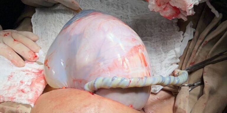 Nascimento raro de gêmeos: bebê nasce envolta pela bolsa amniótica em Irecê