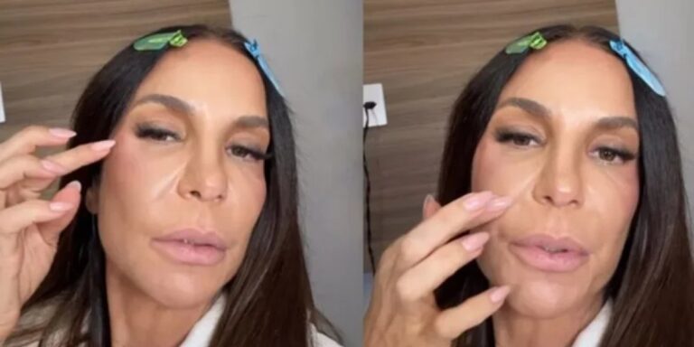 Ivete Sangalo revela que colocou presilhas de titânio no rosto após fratura